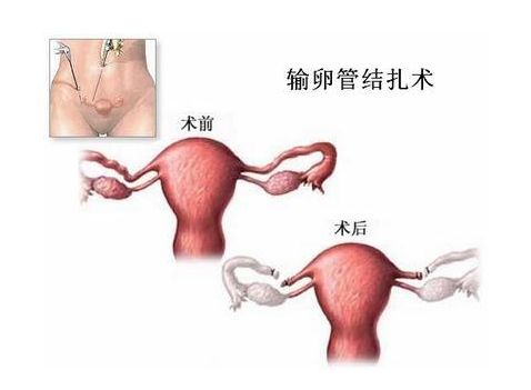 水中分娩