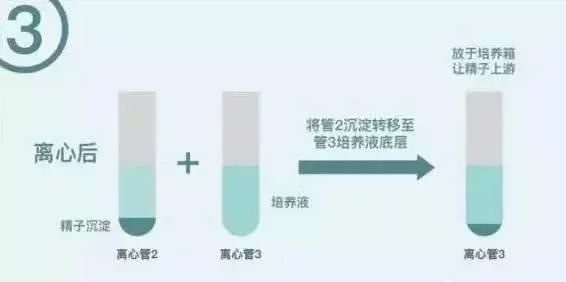 试管婴儿技术