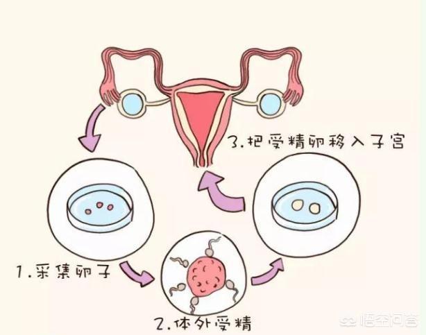 乌克兰试管婴儿