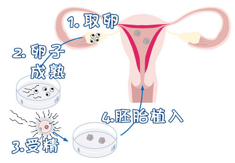 捐卵供卵机构