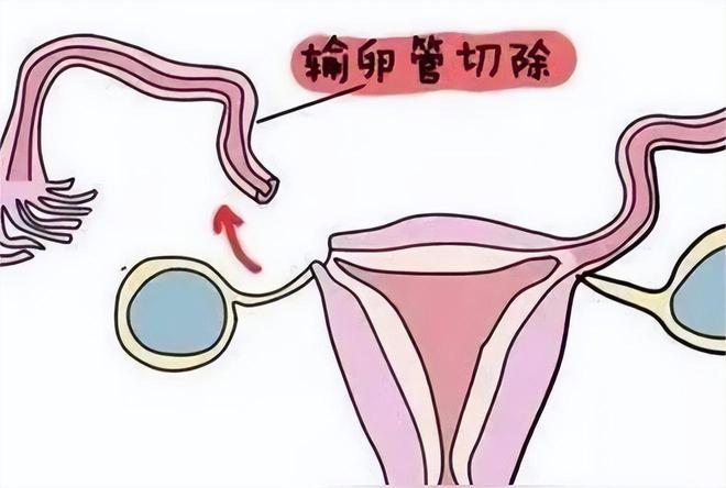 卵子捐赠